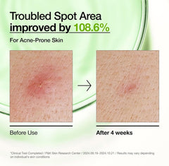 Anua Azelaic Acid 10 Hyaluronic Redness Soothing Serum, Facial Serum for Sensitive Skin, Hyaluronic Acid, Niacinamide, Spot Care, Natural Colour, Vegan, Korean Skincare (30 ml / 1.01 fl oz.)